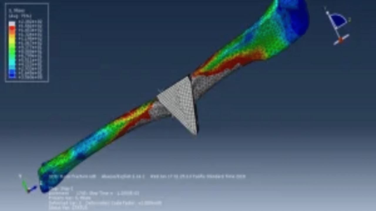 Simulating Femur Bone Fracture Under Rigid Body Impact Using Abaqus ...