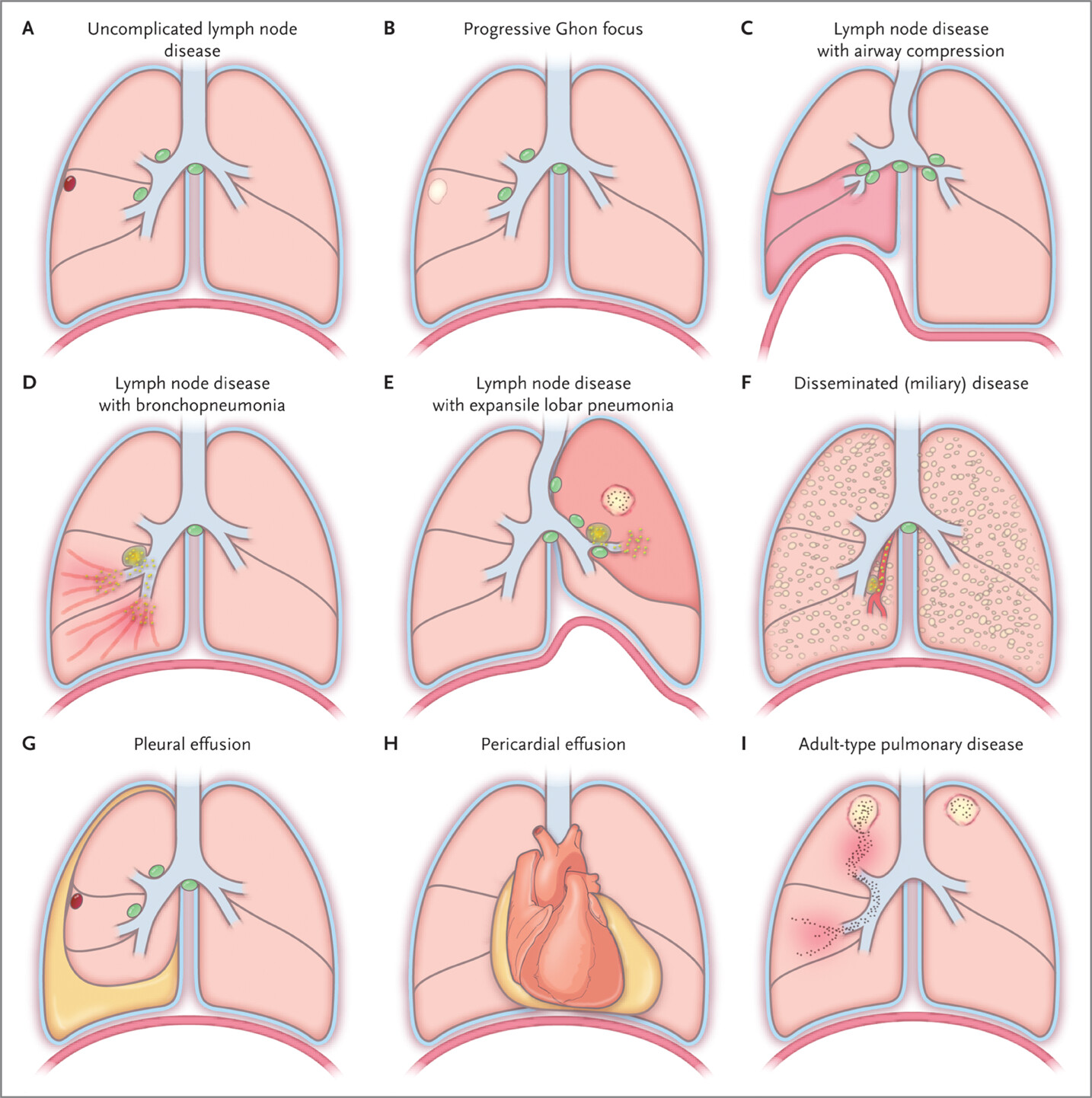 Tuberculosis in Pakistan:  A Persistent Public Health Challenge​