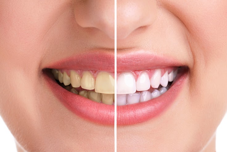 Know The Advantages of a Brighter Smile