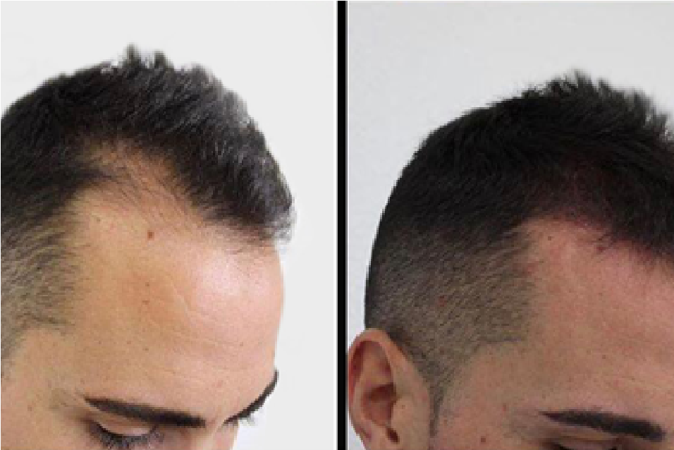 What Benefits Can Hair Transplantation Offer? - Bookmarks My Webs