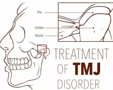 How Effective Are Trigger Point Injections Tmj?