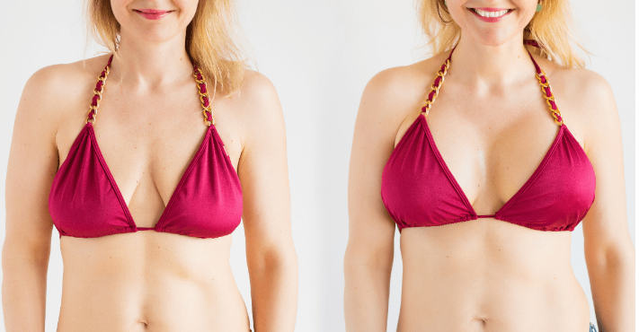Learn Why Fat Transfer Is So Much Beneficial for Breast Augmentation - New York Times Now