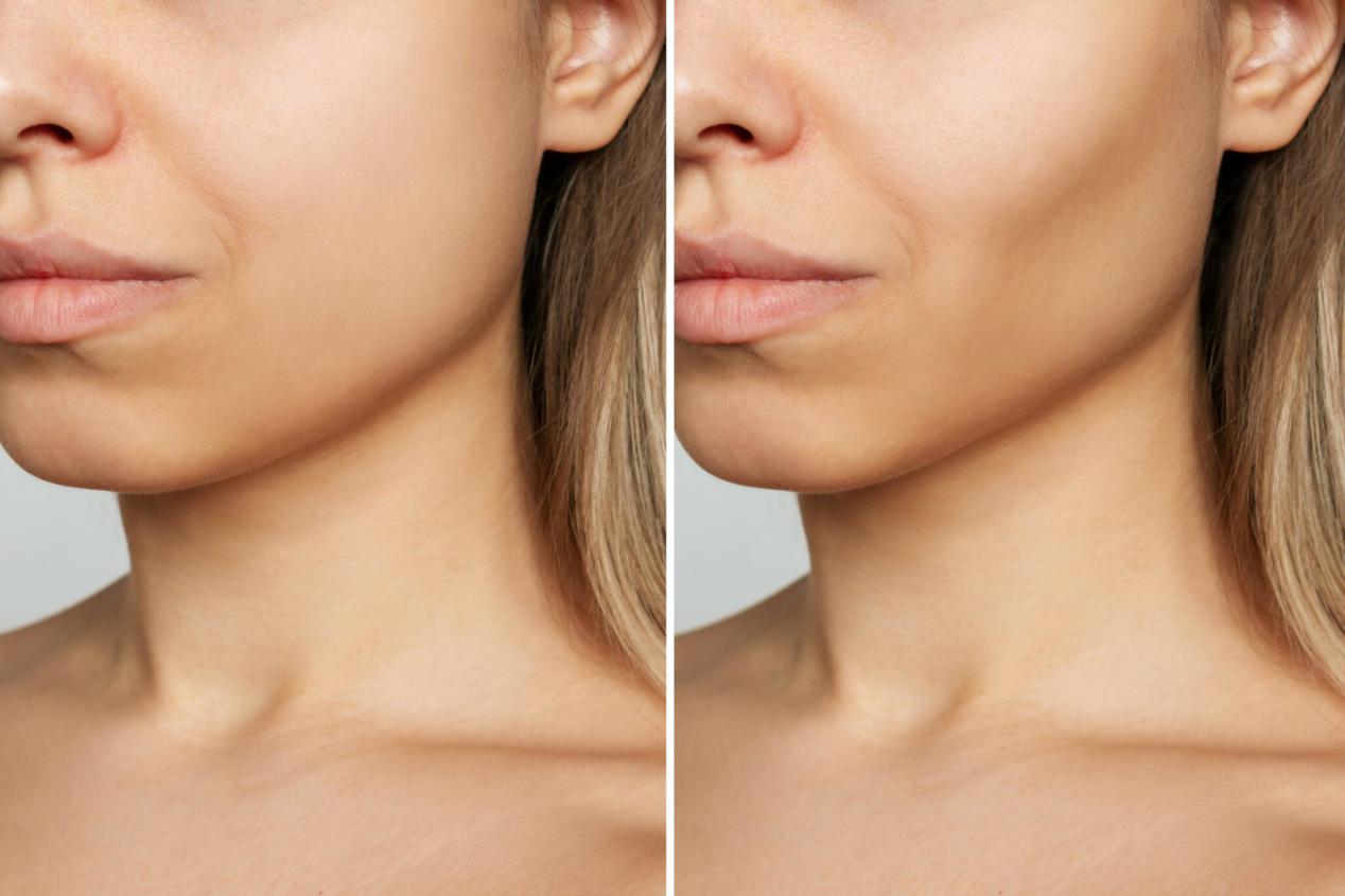 Non-Surgical Jawline Contouring: What You Can Expect | Health Best Answers