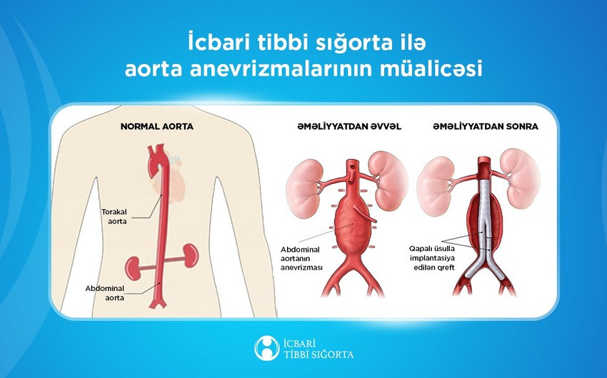 İcbari tibbi sığorta ötən illə bağlı statistika açıqladı