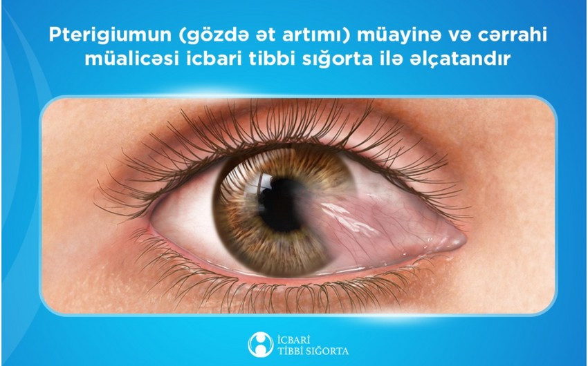 Ötən il icbari tibbi sığorta hesabına gözdə ət artımı üzrə 2 mindən çox əməliyyat icra olunub