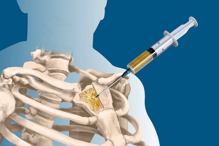 Sümük iliyi xəstəliyinin müalicəsində xarici donorlardan istifadə olunacaq -
