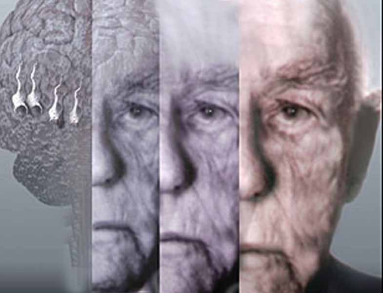 Alzheimer xəstəliyi getdikcə daha gənc yaşlarda görünür –