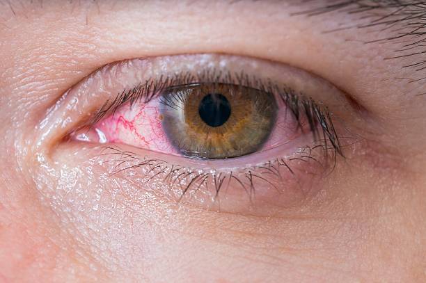 Koronavirus gözə necə təsir edir? - Açıqlama