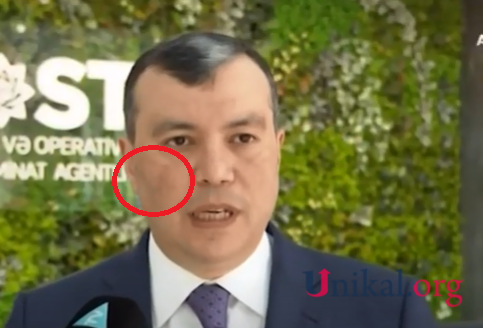 Nazir&nbsp;Sahil Babayevdə xəstəlik aşkarlanıb - FOTO