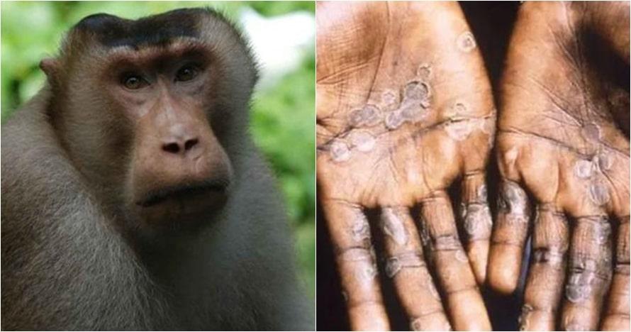 Türkiyədə "meymun çiçəyi" virusu aşkarlanıb?&nbsp;- Nazirdən açıqlama