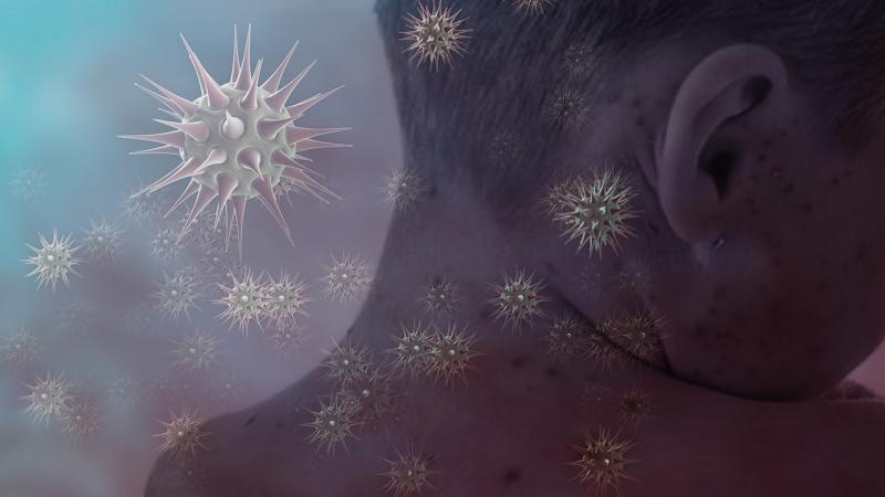 İndoneziyada qızılca epidemiyası: 17 nəfər ölüb