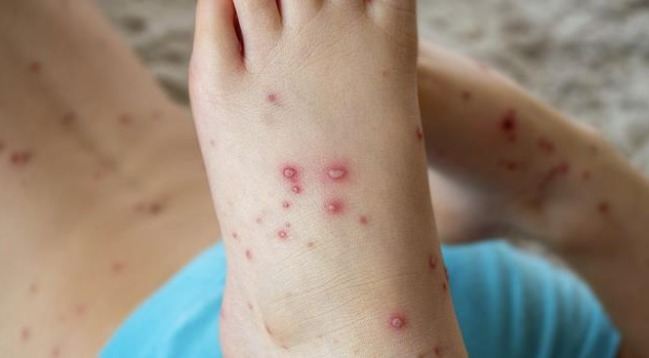 Dünyada yeni epidemiya xəbərdarlığı: Pomidor qripi yayılır