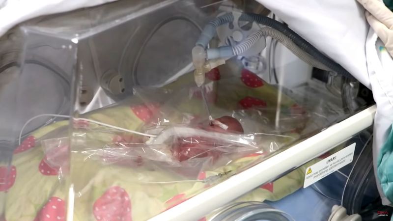 310 qram çəkili uşaq doğuldu - Yaşama şansı azdır - VİDEO