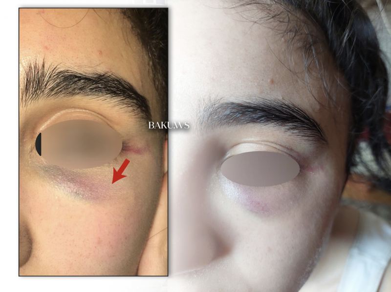 Məktəbli qız Bakı məktəbində vəhşicəsinə döyüldü - FOTO/VİDEO - YENİLƏNİB 