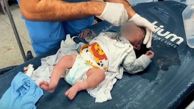 ÜST: Qəzzalı həkimlər anesteziyasız əməliyyatlar və amputasiyalar edirlər 