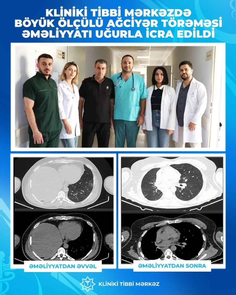 İki uzman həkim əməliyyat etdi, onkoloji xəstə sağaldı 