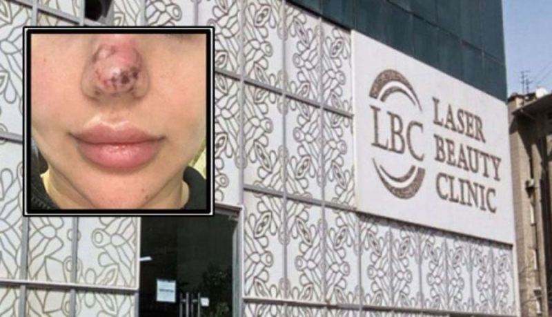 \"Əməliyyatdan 4 gün sonra burnum qaraldı, 5 ay işə çıxa bilmədim\" - Daha bir \"estetika\" dəhşəti - FOTO
