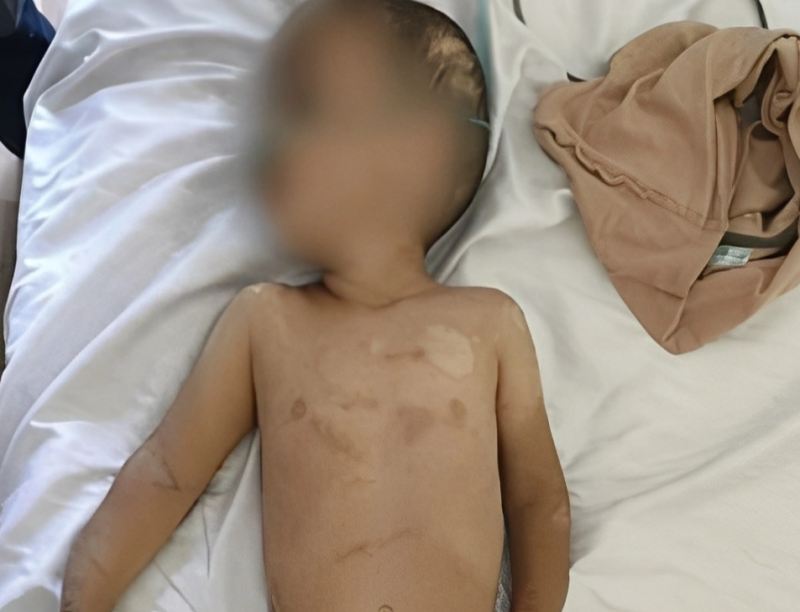 Ağdamda atası tərəfindən döyülən ikiyaşlı Musanın vəziyyəti açıqlanıb 