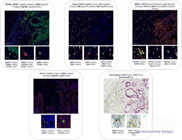 Multiplex immunohistochemistry for tumor microenvironment profiling: ROI-based analytics across tissues