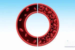 Pernicious Anemia Through Time: From Liver Therapy to Lifelong Vitamin B12 Replacement — An Analytical Synthesis