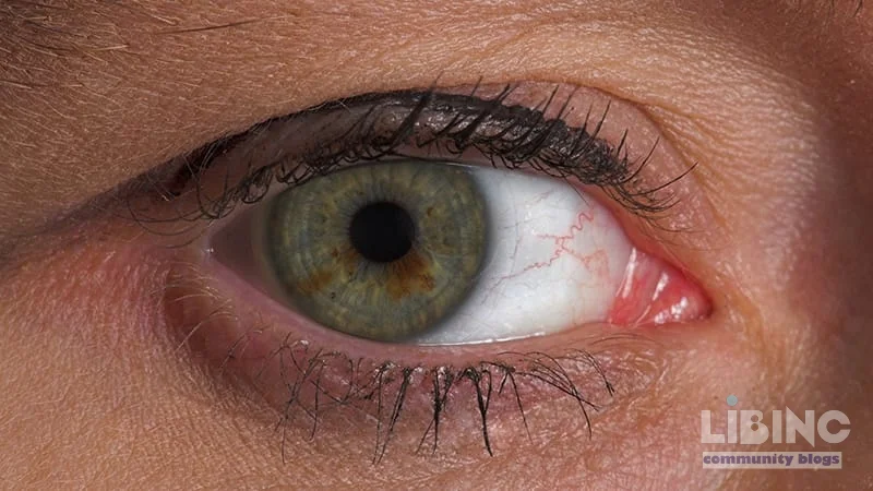 Ixoberogene soroparvovec (Ixo-vec) for neovascular AMD: a five-year extension analysis and implications for long-term treatment burden