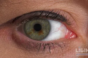 Ixoberogene soroparvovec (Ixo-vec) for neovascular AMD: a five-year extension analysis and implications for long-term treatment burden